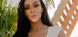 A  vitiligós modell, Winnie Harlow saját fényvédő branddel debütál